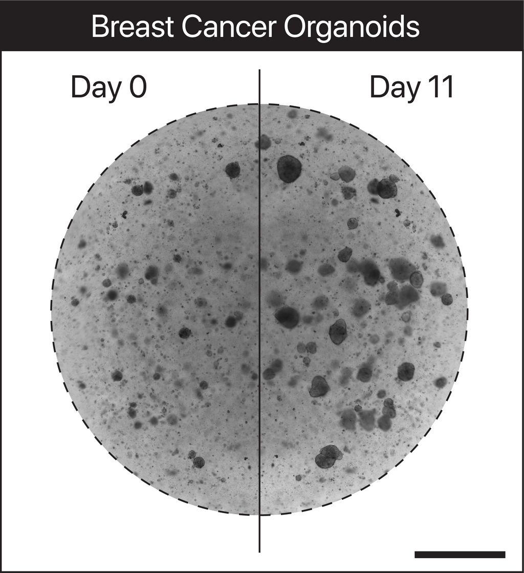 TissueSpec® Lung dECM Hydrogel Kit: Breast cancer organoids cultured in TissueSpec® Lung dECM hydrogel