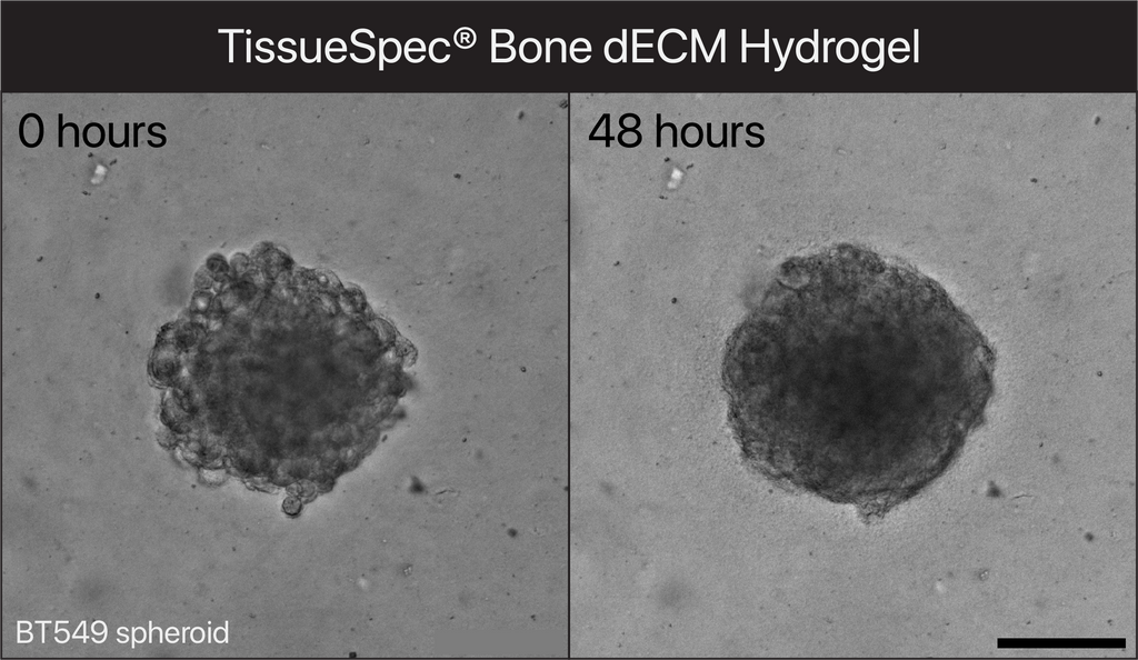 TissueSpec® Bone dECM Hydrogel Kit: 3D cell culture of human breast cancer spheroids.