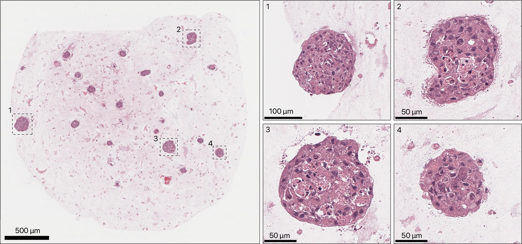 TissueSpec® Multi-Organ Metastasis dECM Hydrogel Kit: Histological staining of breast cancer organoids cultured in TissueSpec® Bone dECM Hydrogel