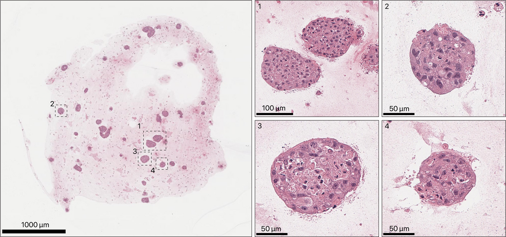 TissueSpec® Multi-Organ Metastasis dECM Hydrogel Kit: Histological staining of breast cancer organoids cultured in TissueSpec® Liver dECM Hydrogel