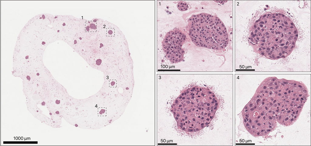 TissueSpec® Multi-Organ Metastasis dECM Hydrogel Kit: Histological staining of breast cancer organoids cultured in TissueSpec® Lung dECM Hydrogel