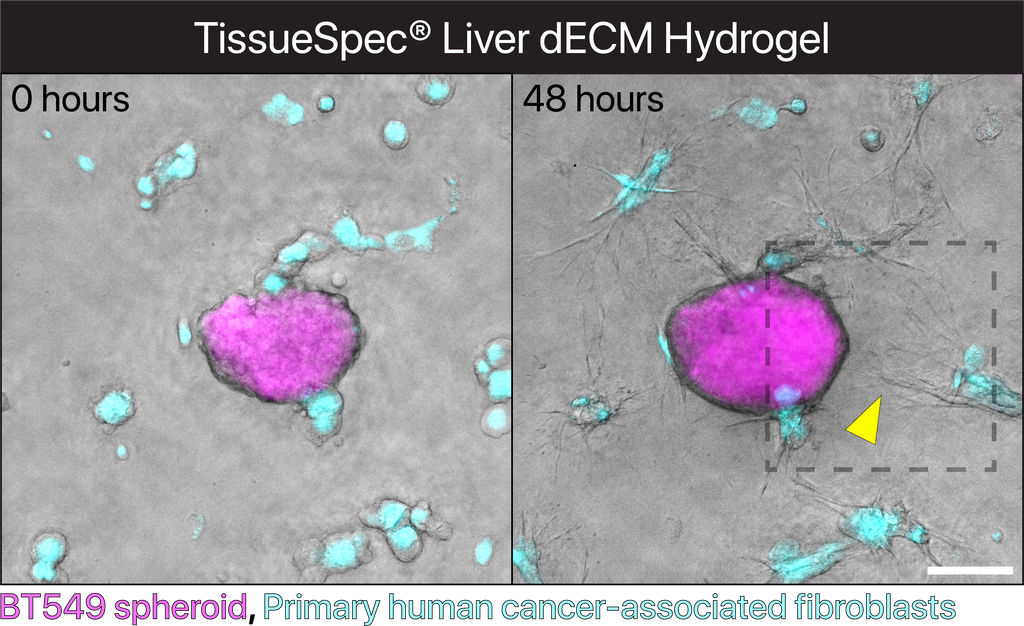 TissueSpec® Liver dECM Hydrogel Kit: 3D co-culture of human breast cancer spheroids and primary cancer-associated fibroblasts.